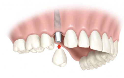 implantatsiya-zubov-s-otstrochennoj-nagruzkoj.jpg (12.73 Kb)